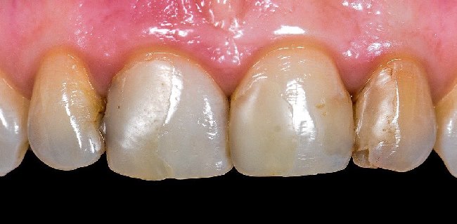 Зубы 12, 11, 21, 22 восстановлены керамическими винирами из пресс керамики Emax