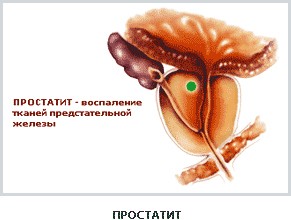 Лечение простатита. эффективное лечение хронического простатита в Нижнем Новгороде