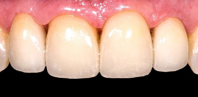 Зубы 12, 11, 21, 22 восстановлены керамическими винирами из пресс керамики Emax