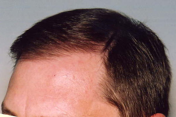 Современные методы пересадки волос