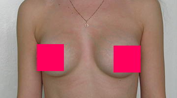 Хирургическая коррекция формы груди