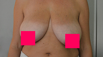 Увеличение груди имплантатами
